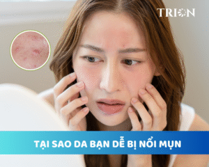 da bi noi mụn lien tuc